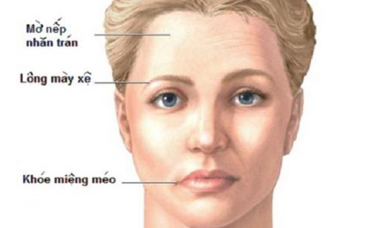 5 biểu hiện đột quỵ bạn cần biết