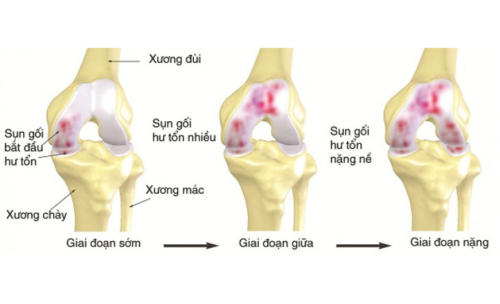 Phòng và trị thoái hóa khớp gối