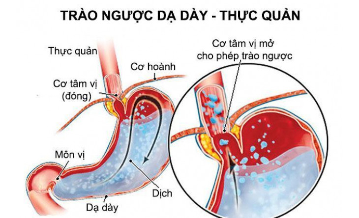 Hội chứng trào ngược dạ dày - thực quản