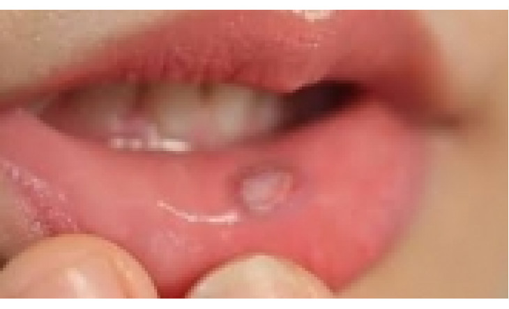 Bí quyết phòng ngừa loét miệng tái phát