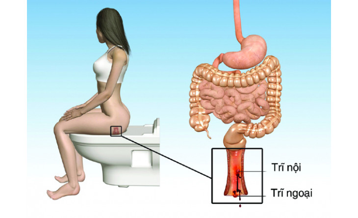Thập nhân cửu… trĩ