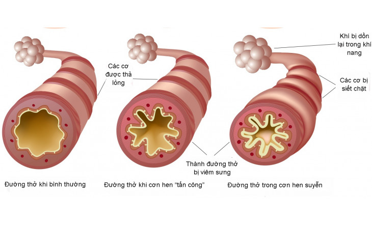 Béo phì có làm tăng nặng bệnh đường hô hấp?