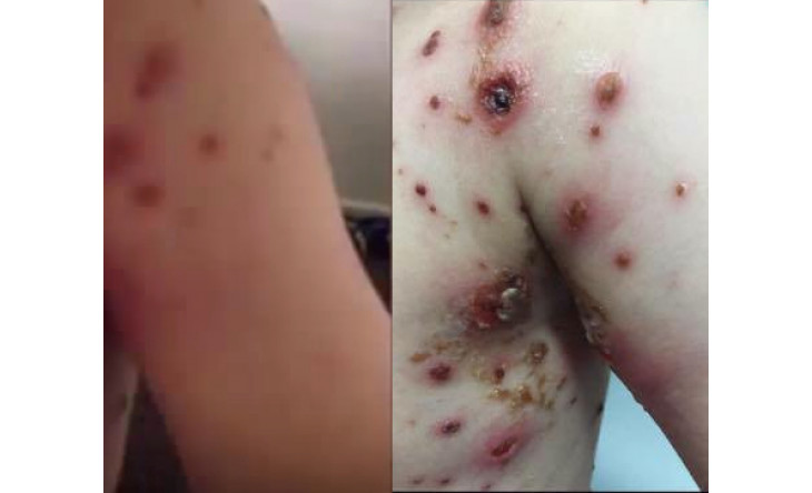 Bôi kem làm trắng da chứa corticoid: Nguy hại khôn lường