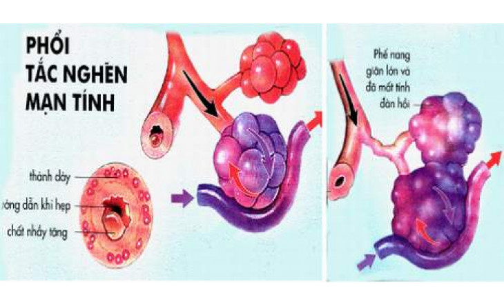 Bệnh phổi tắc nghẽn mạn tính: Những biến chứng đe dọa tính mạng