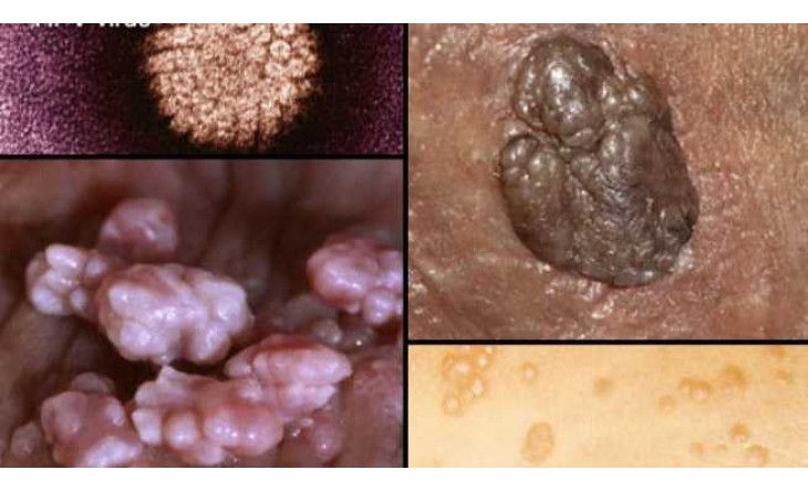 Rợn người hình ảnh chân thực về bệnh lây qua đường tình dục