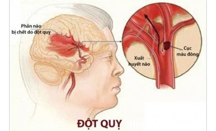 3 dấu hiệu cảnh báo đột quỵ
