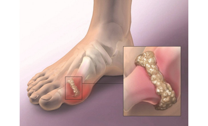 Chữa gút từ trầu không, nước dừa