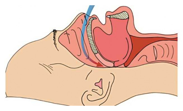 Hội chứng ngưng thở khi ngủ