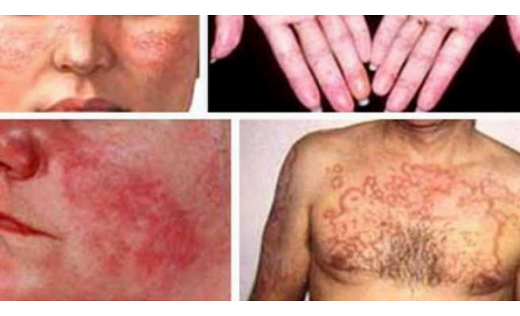 Chữa lupus ban đỏ, cần lưu ý độc tính của thuốc