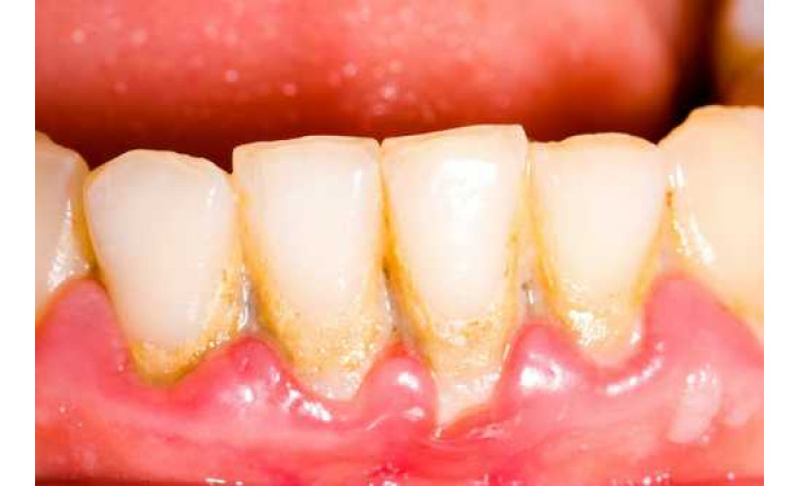 Nguy hiểm ít biết của vôi răng