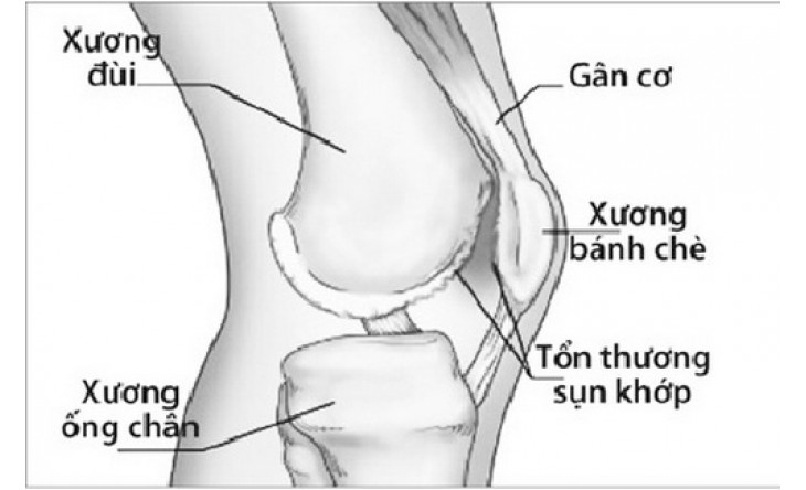 Kháng sinh ciprofloxacin trị nhiễm khuẩn: Trường hợp nào không được dùng?