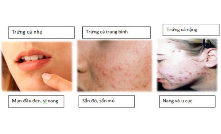 Những lầm tưởng về isotretinoin trị mụn