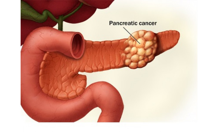 Thêm 4 dạng ung thư tuyến tụy