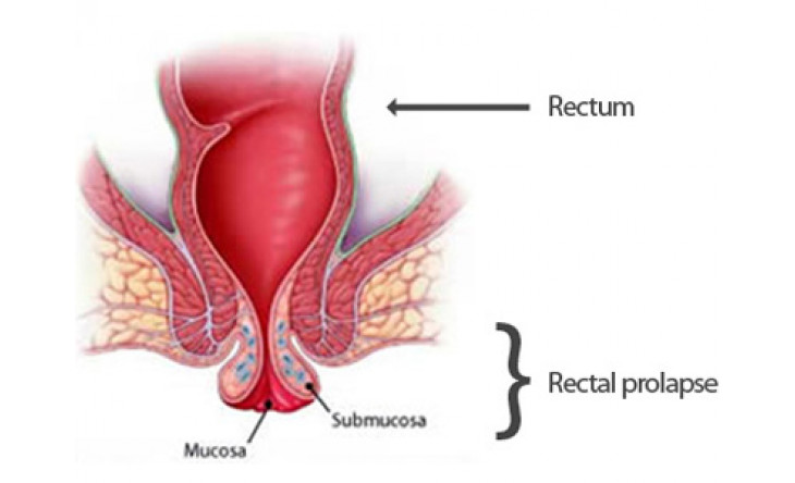 Bài thuốc giúp chữa sa trực tràng