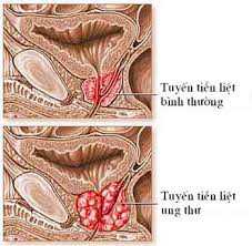 ung-thu-tlt-1416798922451